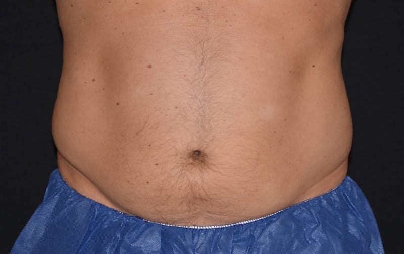 CoolSculpting Before & After Gallery - Patient 328997 - Image 2