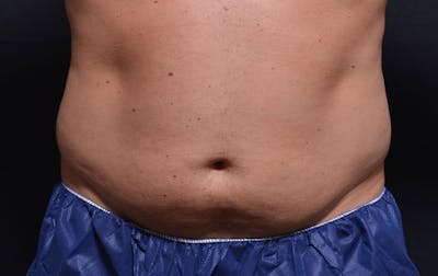 CoolSculpting Before & After Gallery - Patient 328997 - Image 1