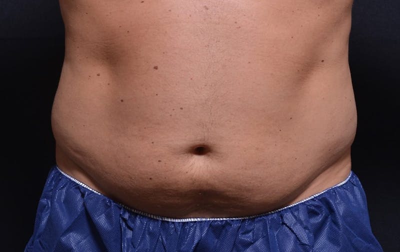 CoolSculpting Before & After Gallery - Patient 328997 - Image 1