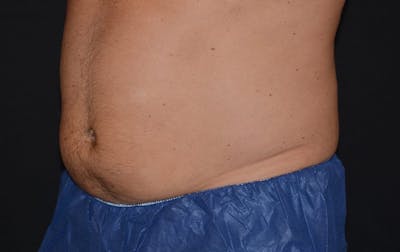 CoolSculpting Before & After Gallery - Patient 267868 - Image 2