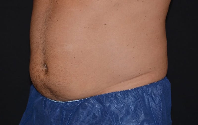 CoolSculpting Before & After Gallery - Patient 267868 - Image 2