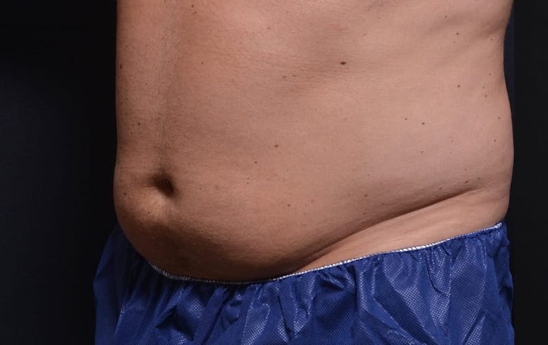 CoolSculpting Before & After Gallery - Patient 267868 - Image 1