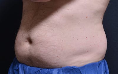 CoolSculpting Before & After Gallery - Patient 887676 - Image 2