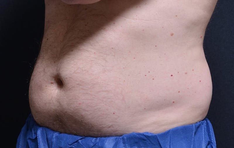 CoolSculpting Before & After Gallery - Patient 397323 - Image 2