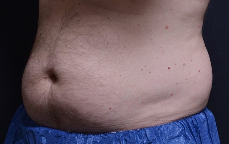 CoolSculpting Before & After Gallery - Patient 397323 - Image 1
