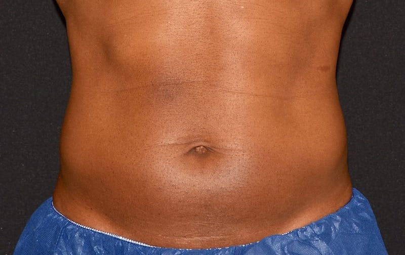 CoolSculpting Before & After Gallery - Patient 940124 - Image 2