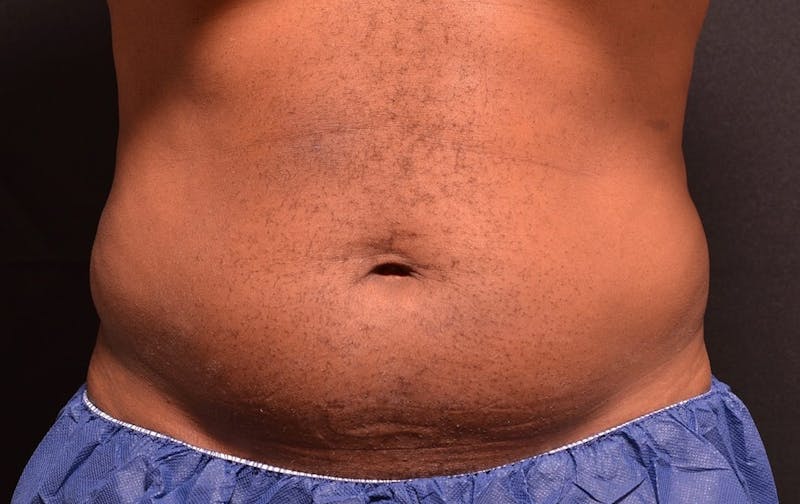 CoolSculpting Before & After Gallery - Patient 940124 - Image 1