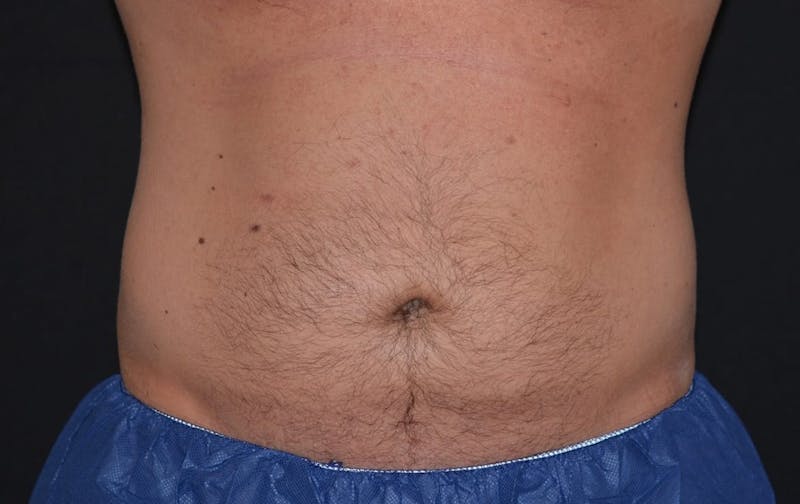 CoolSculpting Before & After Gallery - Patient 484265 - Image 2