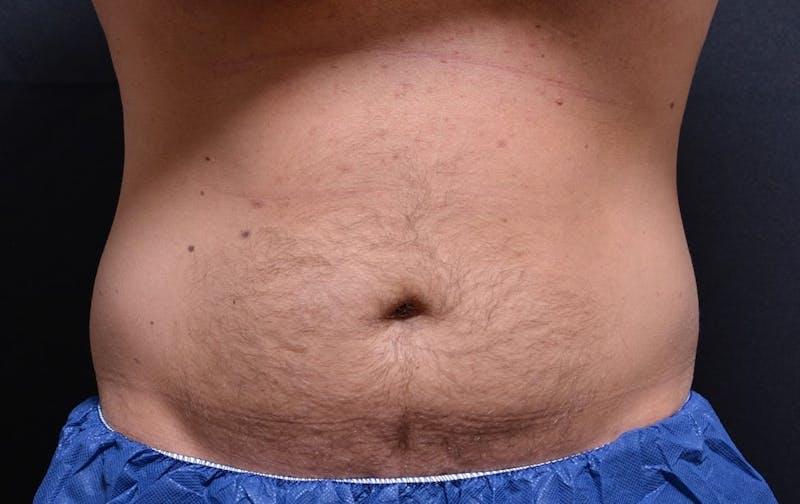 CoolSculpting Before & After Gallery - Patient 484265 - Image 1