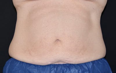 CoolSculpting Before & After Gallery - Patient 103243 - Image 2