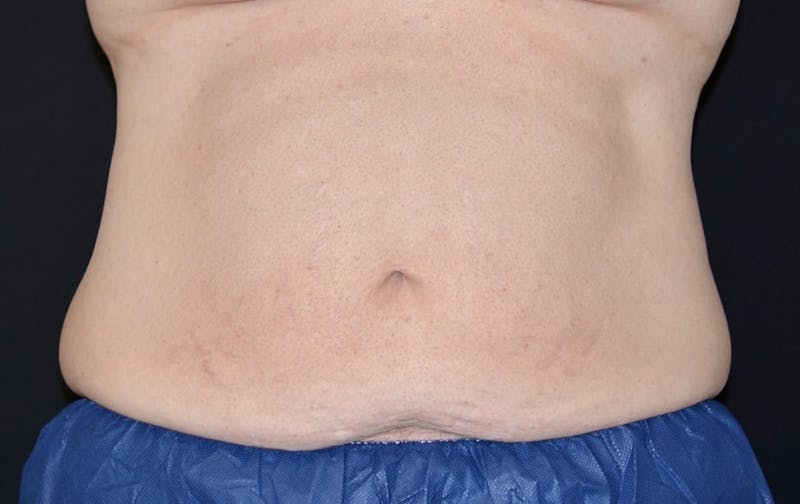 CoolSculpting Before & After Gallery - Patient 194434 - Image 2