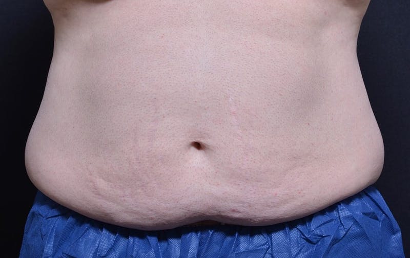 CoolSculpting Before & After Gallery - Patient 194434 - Image 1