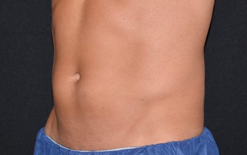 CoolSculpting Before & After Gallery - Patient 234329 - Image 2
