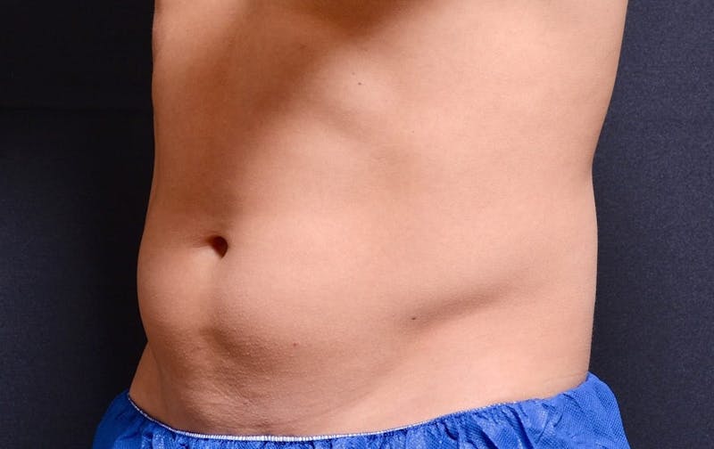 CoolSculpting Before & After Gallery - Patient 234329 - Image 1