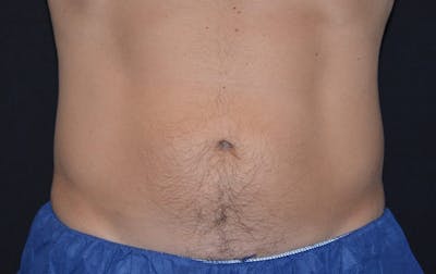 CoolSculpting Before & After Gallery - Patient 258552 - Image 2