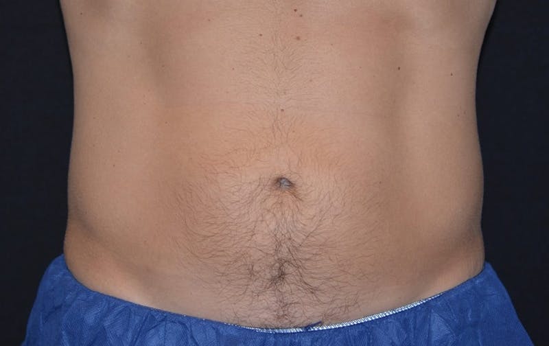 CoolSculpting Before & After Gallery - Patient 258552 - Image 2