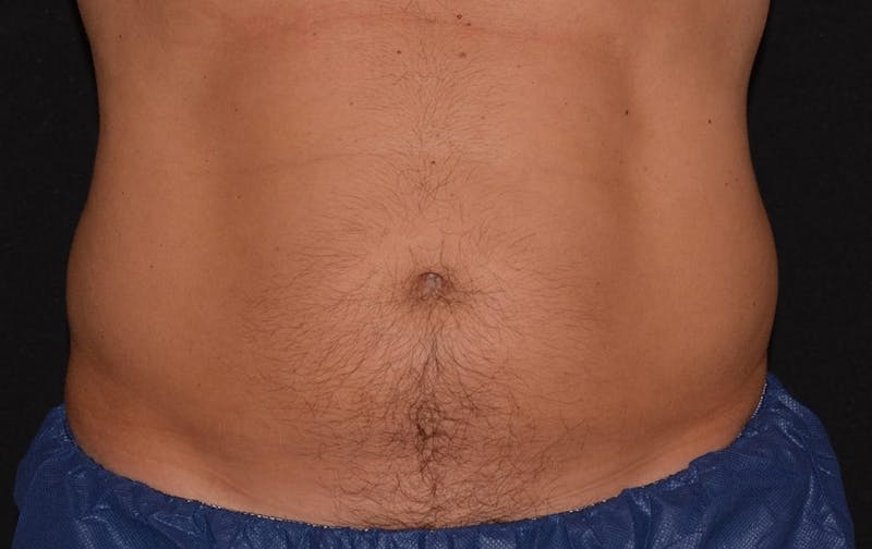 CoolSculpting Before & After Gallery - Patient 258552 - Image 1