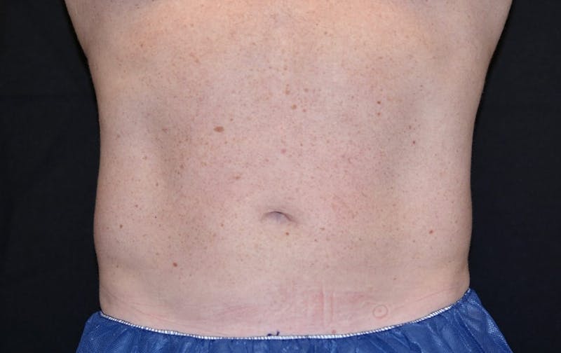 CoolSculpting Before & After Gallery - Patient 291982 - Image 2
