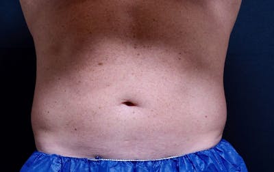 CoolSculpting Before & After Gallery - Patient 291982 - Image 1