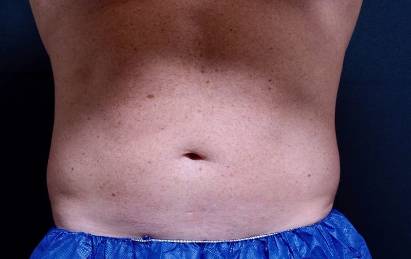 CoolSculpting Before & After Gallery - Patient 291982 - Image 1