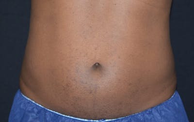 CoolSculpting Before & After Gallery - Patient 222661 - Image 2