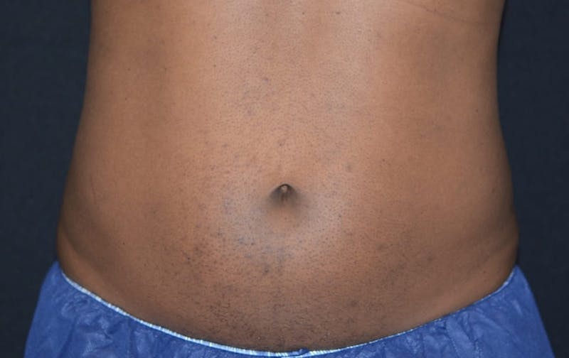CoolSculpting Before & After Gallery - Patient 222661 - Image 2