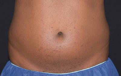 CoolSculpting Before & After Gallery - Patient 222661 - Image 1