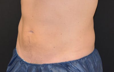 CoolSculpting Before & After Gallery - Patient 343357 - Image 2