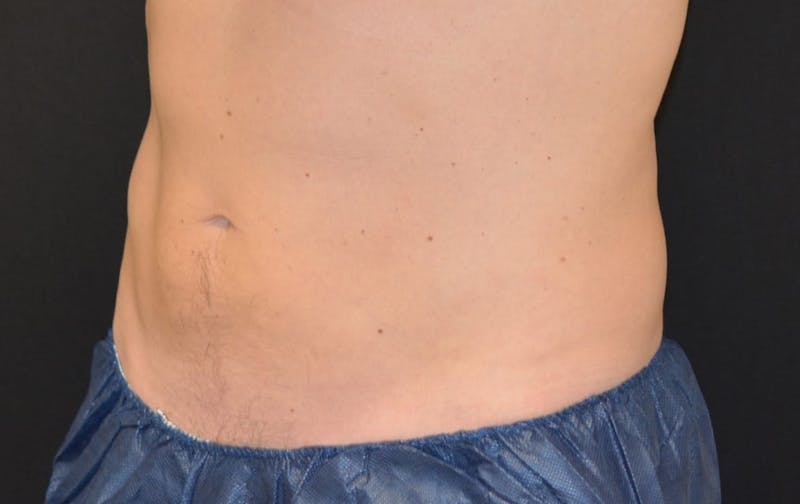 CoolSculpting Before & After Gallery - Patient 343357 - Image 2