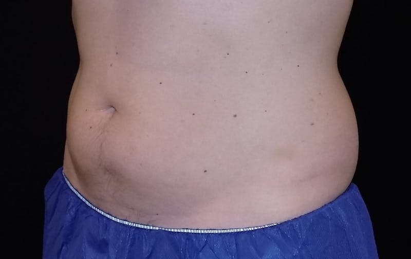 CoolSculpting Before & After Gallery - Patient 343357 - Image 1