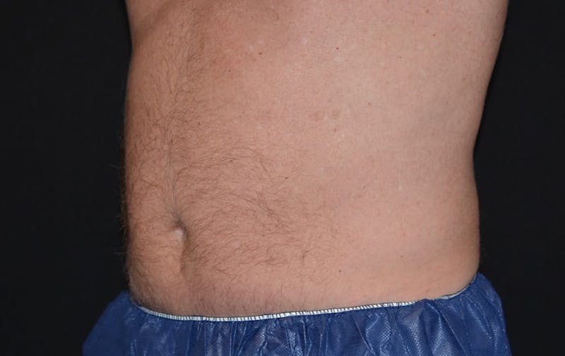 CoolSculpting Before & After Gallery - Patient 899694 - Image 2
