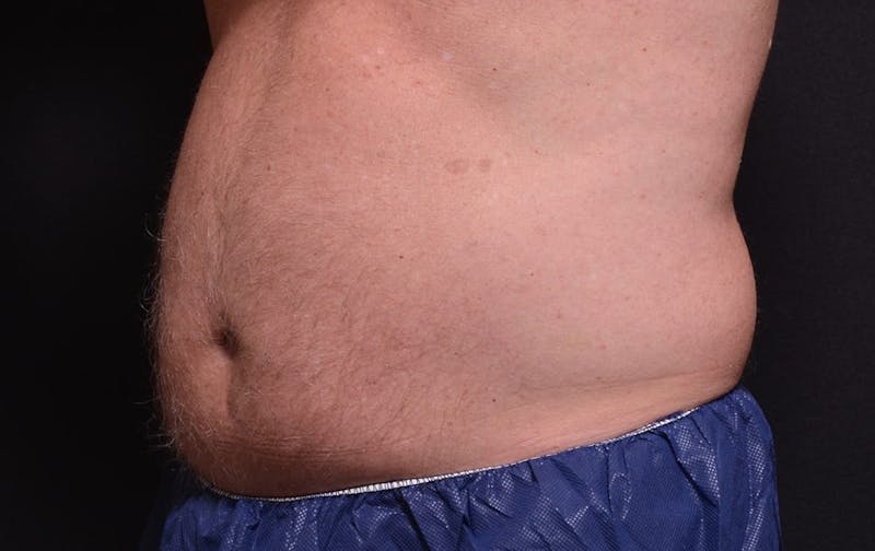 CoolSculpting Before & After Gallery - Patient 899694 - Image 1