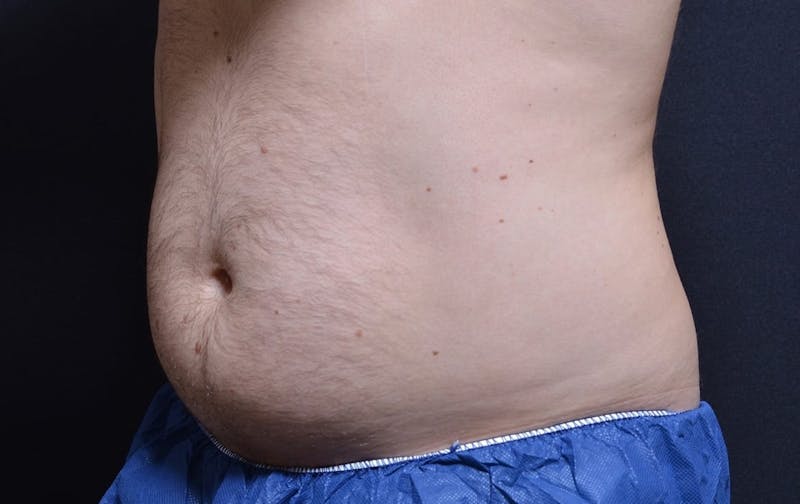 CoolSculpting Before & After Gallery - Patient 265143 - Image 2