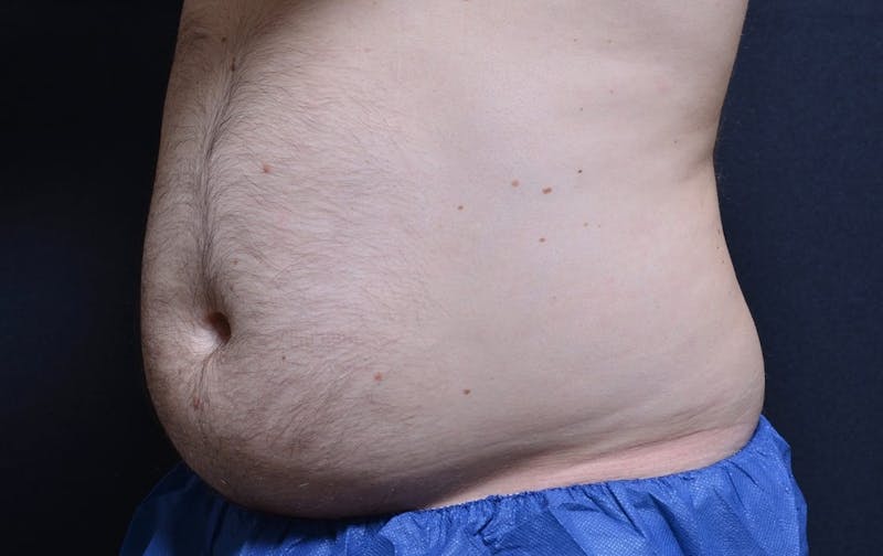 CoolSculpting Before & After Gallery - Patient 265143 - Image 1