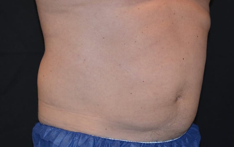 CoolSculpting Before & After Gallery - Patient 134834 - Image 2