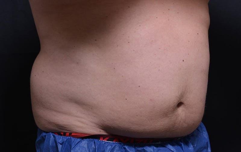 CoolSculpting Before & After Gallery - Patient 134834 - Image 1