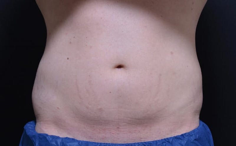 CoolSculpting Before & After Gallery - Patient 121862 - Image 1