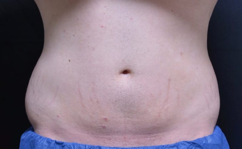 CoolSculpting Before & After Gallery - Patient 121862 - Image 2