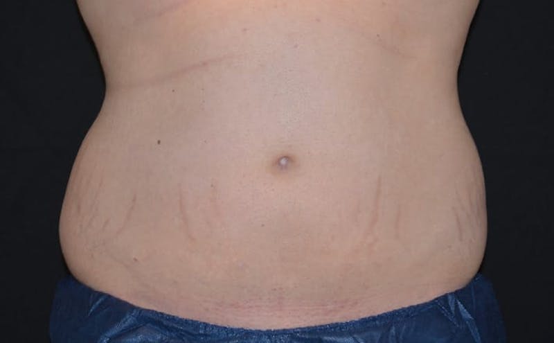 CoolSculpting Before & After Gallery - Patient 121862 - Image 3