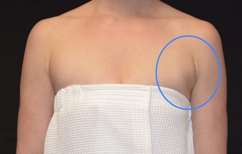 CoolSculpting Before & After Gallery - Patient 731207 - Image 2
