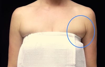 CoolSculpting Before & After Gallery - Patient 731207 - Image 1