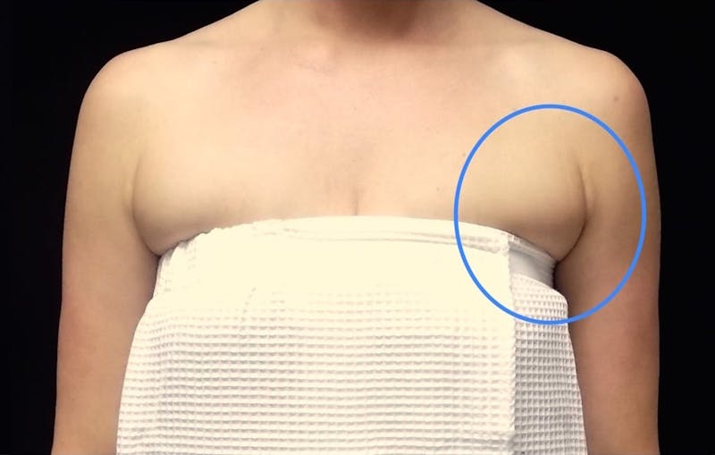 CoolSculpting Before & After Gallery - Patient 731207 - Image 1