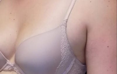 CoolSculpting Before & After Gallery - Patient 361706 - Image 1