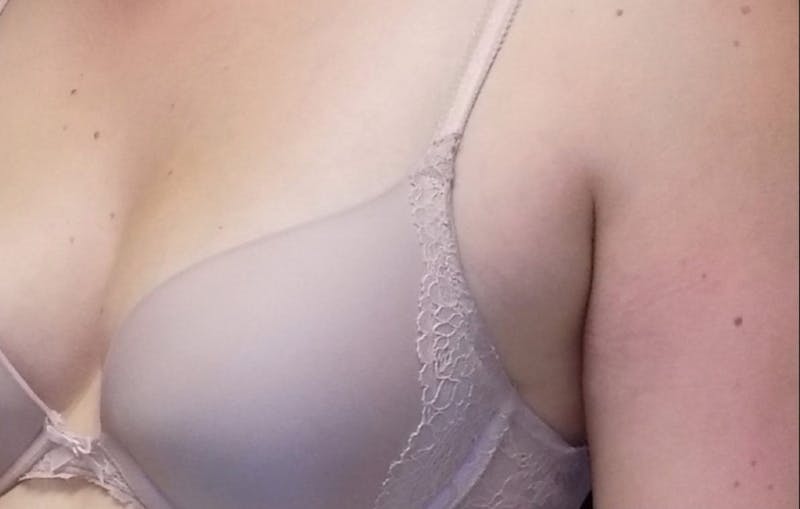 CoolSculpting Before & After Gallery - Patient 361706 - Image 1