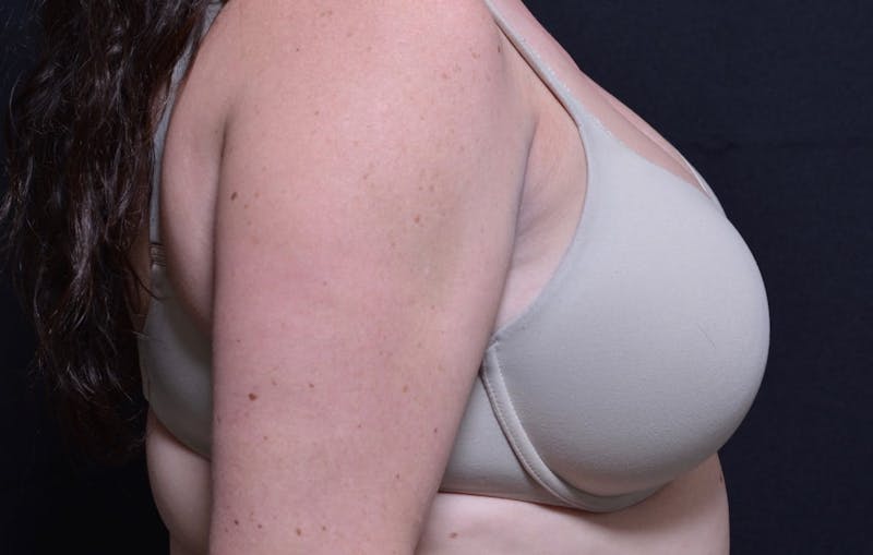 CoolSculpting Before & After Gallery - Patient 742972 - Image 4