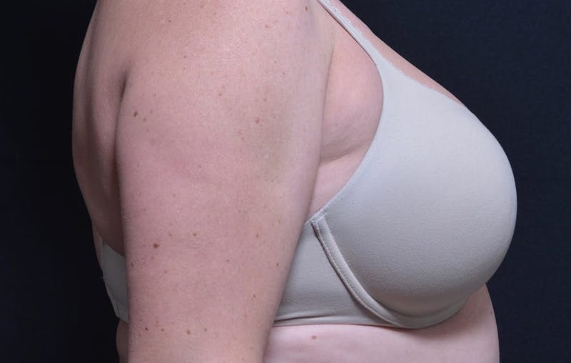 CoolSculpting Before & After Gallery - Patient 742972 - Image 3