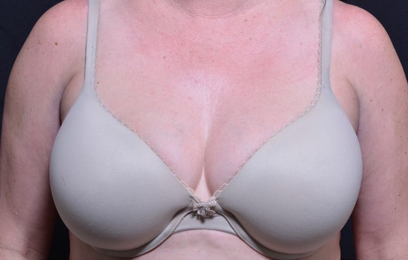 CoolSculpting Before & After Gallery - Patient 742972 - Image 2