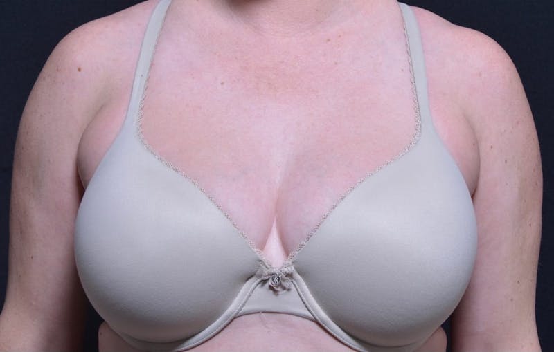 CoolSculpting Before & After Gallery - Patient 742972 - Image 1