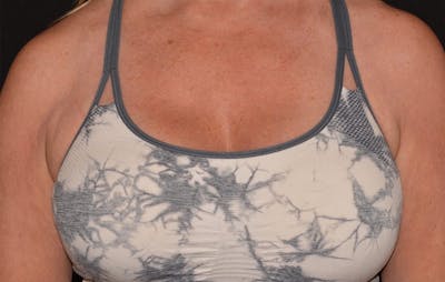 CoolSculpting Before & After Gallery - Patient 355911 - Image 2