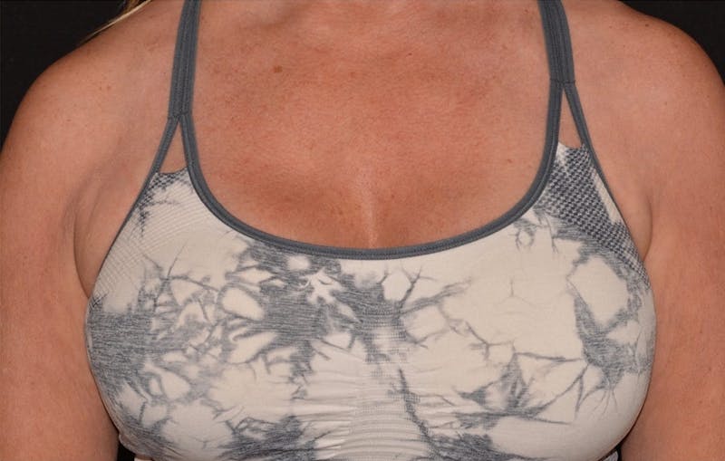 CoolSculpting Before & After Gallery - Patient 355911 - Image 2